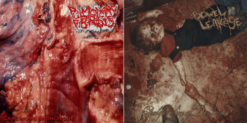 Bowel Leakage : Pulmonary Fibrosis - Bowel Leakage